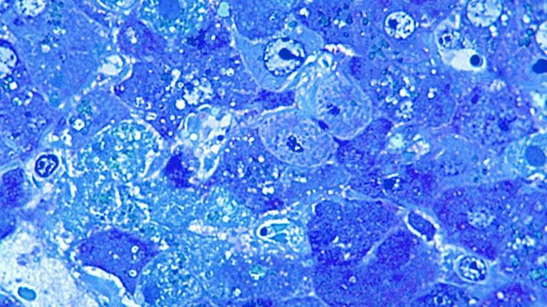 Lassa fever: Patient dies of Ebola-like virus as third case in UK confirmed, health officials say