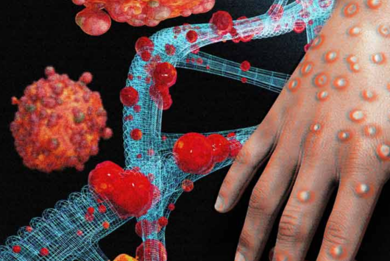 Sri Lanka’s first monkeypox patient reported!