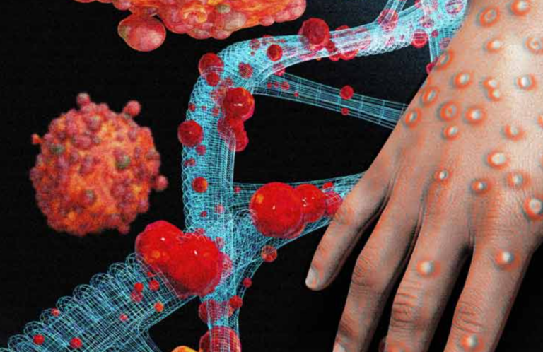The second monkeypox patient reported from Sri Lanka!