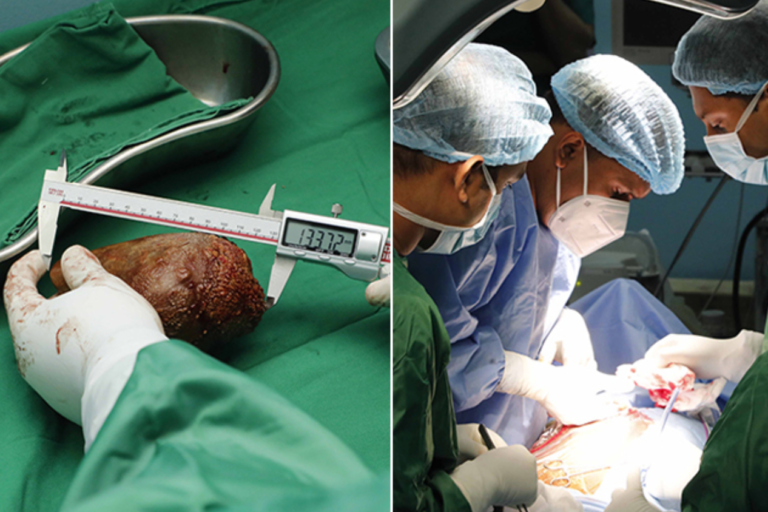 Sri Lanka Army Doctors Achieve Guinness World Record for Largest Kidney Stone Removal