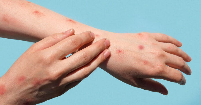 monkeypox-rash-symptoms