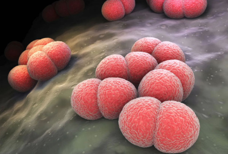 Meningococcal Meningitis Case Identified in Colombo District Following Galle Prison Outbreak