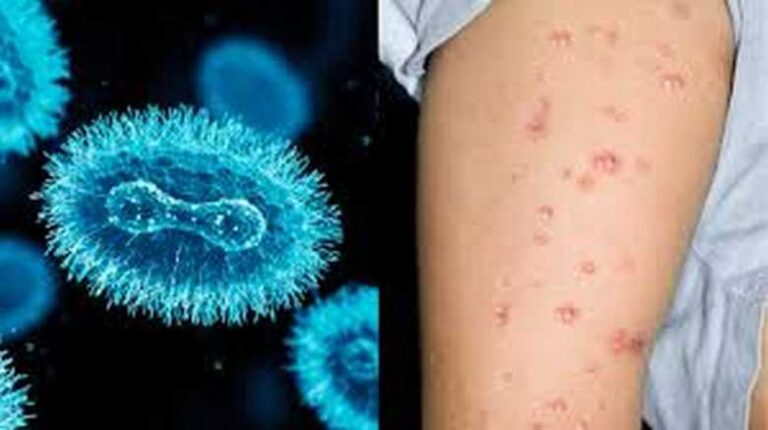 Sri Lanka boosts vigilance amidst rising global monkeypox cases, urges end to stigma surrounding disease