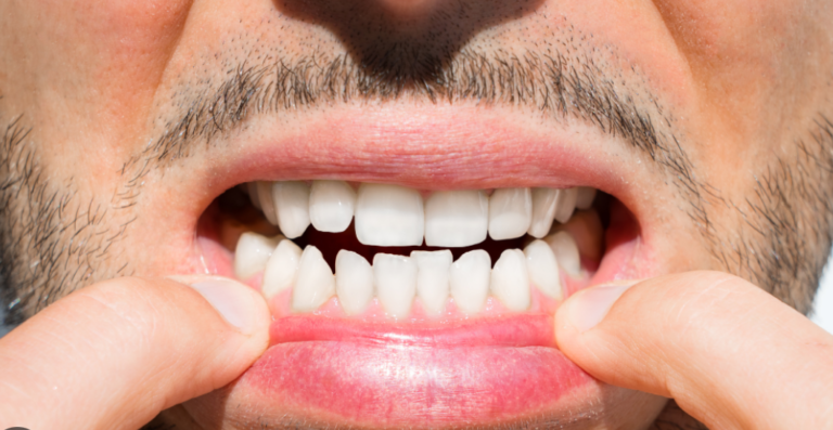 63% of Sri Lankan Children Suffer from Tooth Decay, Oral Cancer Most Common Among Men