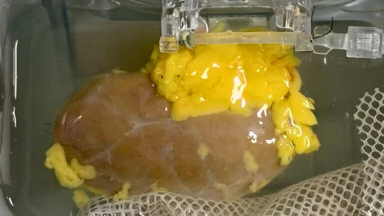 Breakthrough: Scientists Create ‘Universal’ Kidney To Match Any Blood Type