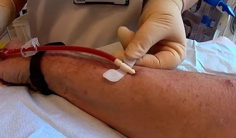 Sharp Rise in Dialysis Needle Prices Sparks Concern Amid Hospital Shortages